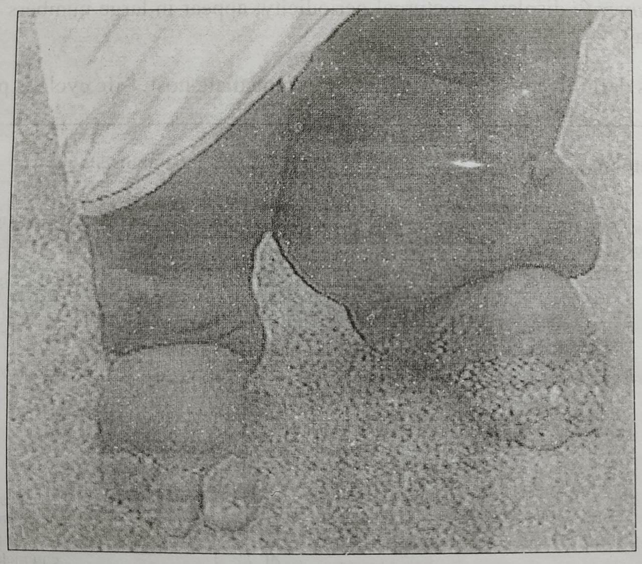 Lymphatic filariasis