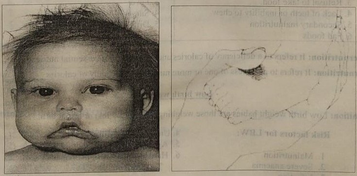 Protein Energy Malnutrition 