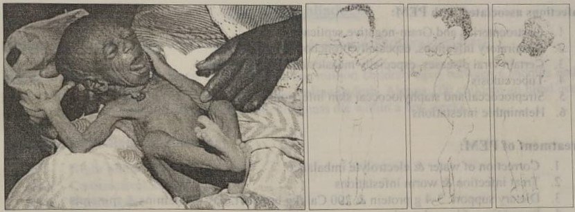 Protein Energy Malnutrition 